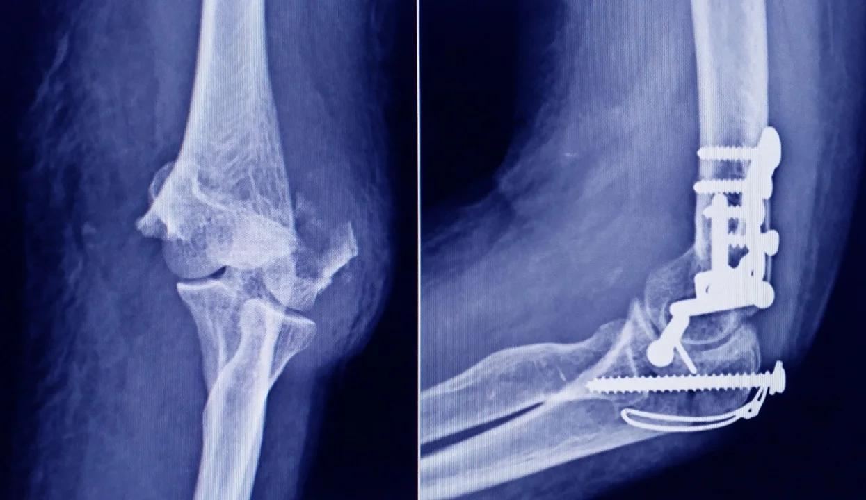 Advierten sobre un tornillo utilizado en cirugías traumatológicas