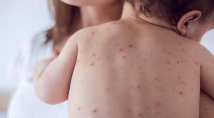 Primer caso de sarampión en la ciudad de Santa Fe